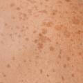 Zap Away Sunspots: A Deep Dive into Laser Treatments for Hyperpigmentation