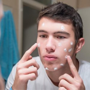 male_teen_with_acne_cream