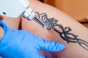 Laser Tattoo Removal | Premier Spa & Laser Center | Newark DE