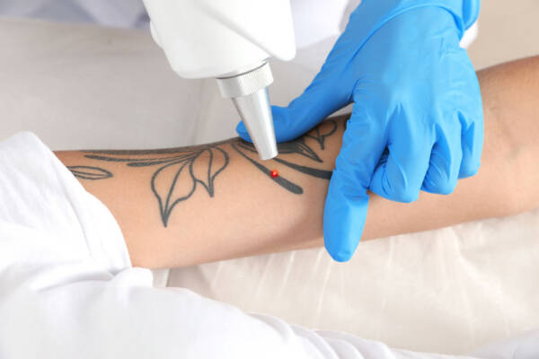 Tattoo Removal Premier Spa and Laser Center Newark, DE
