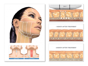 Ultherapy Process Graphic