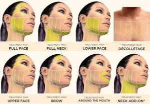 Ultherapy Treatment Graphic