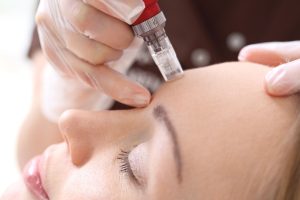 A woman is getting a microneedling Delaware treatment done.