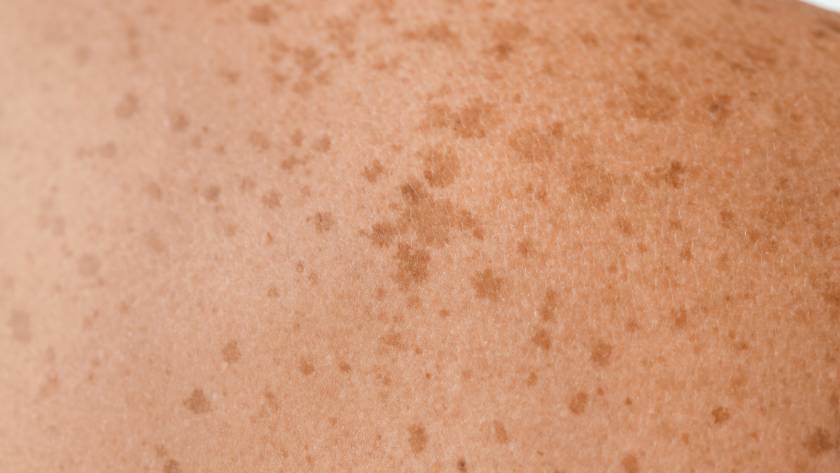 sun spots on person's back