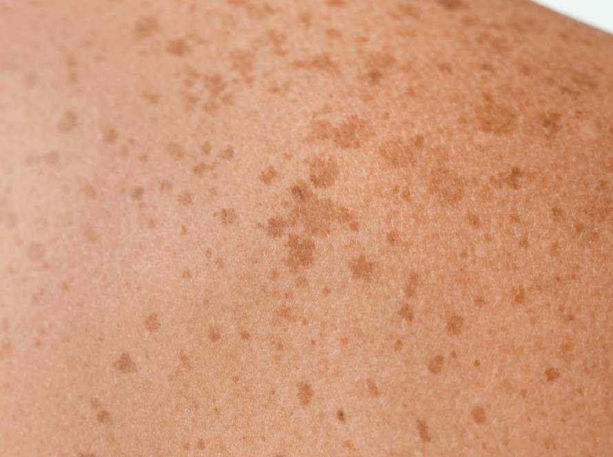 sun spots on person's back